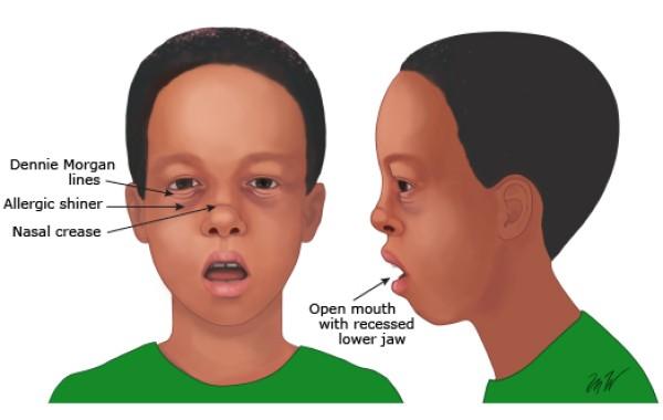 ciri-adenoid-facies-anak