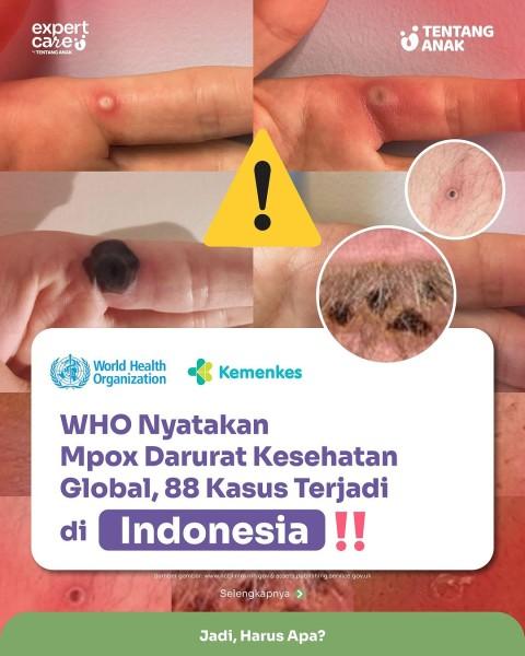 Gejala Monkeypox & Cara Penularan Monkeypox