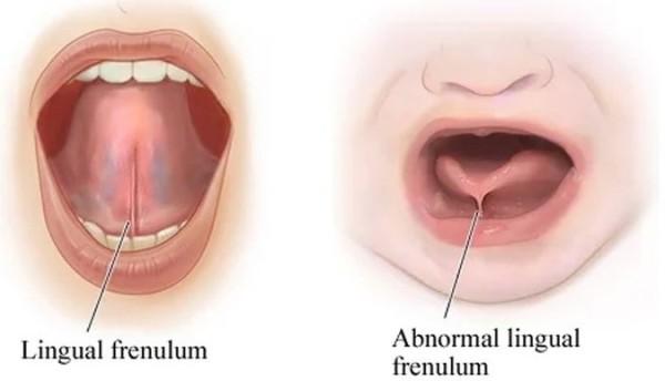 insisi tongue tidak direkomendasikan, ketahui syaratnya