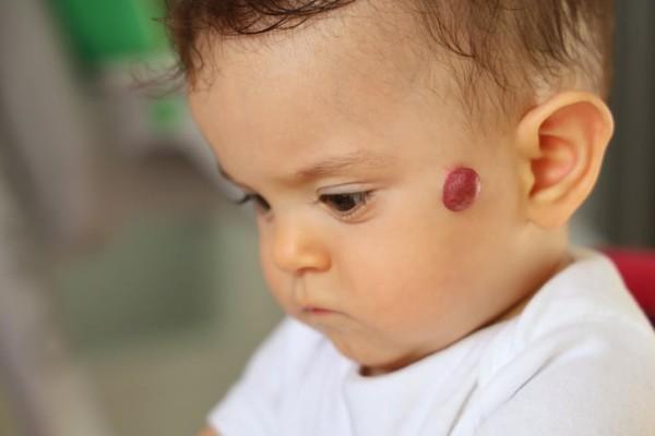 hemangioma-benjolan-merah-bayi