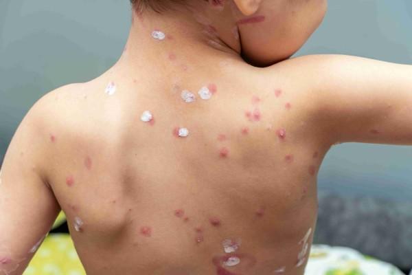 Mengenal Gejala dan Pengobatan Kudis (Scabies) pada Anak
