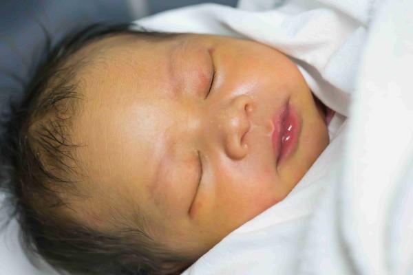Mengenal Penyakit Kuning Pada Bayi