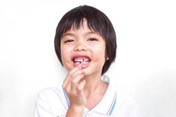 gigi susu bolong
