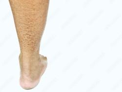 /artikel/mengenal-iktiosis-kulit-kering-bersisik-seperti-ikan/'s thumbnail