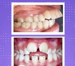 /artikel/3-kebiasaan-bikin-gigi-anak-tonggos/'s thumbnail